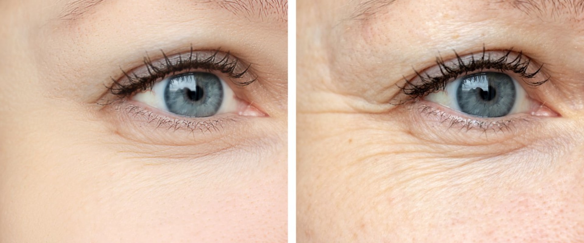 Reduced Appearance of Wrinkles and Fine Lines: A Comprehensive Overview