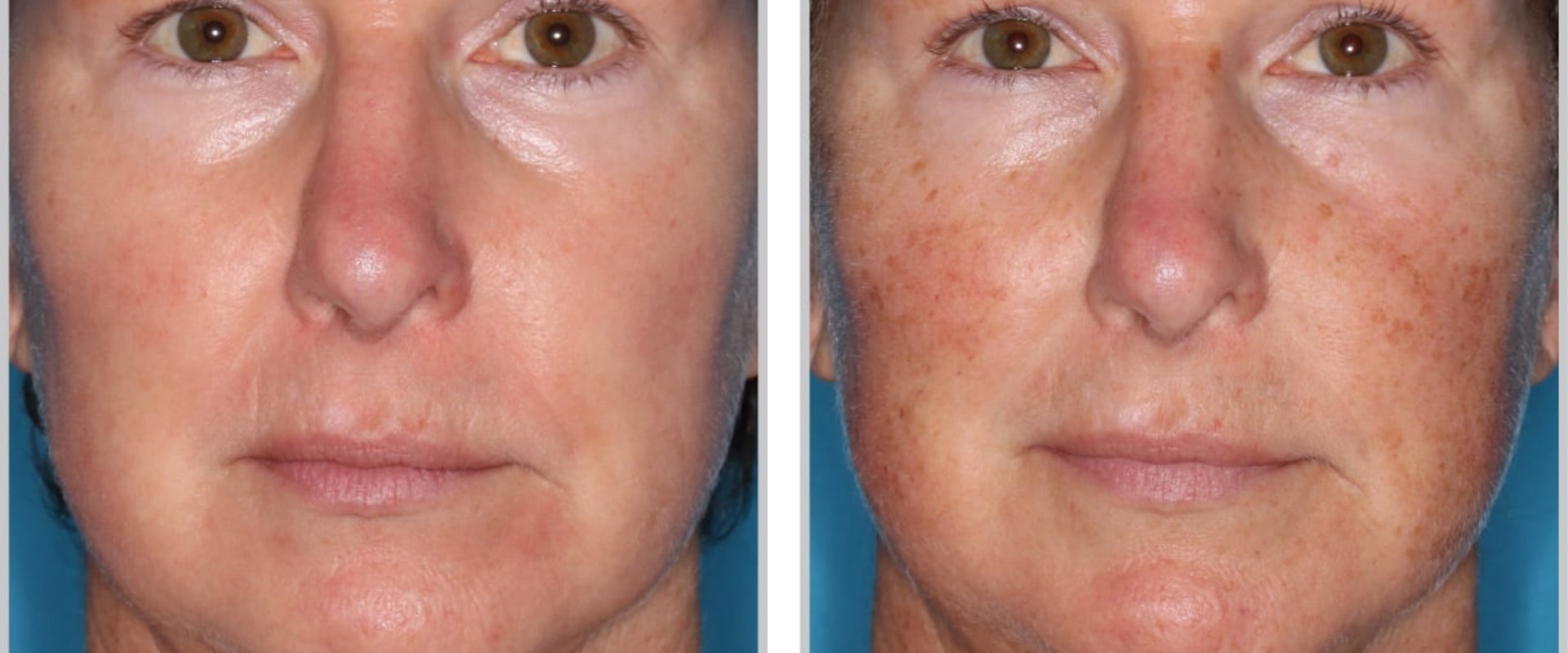 Reviews of Laser Skin Resurfacing Treatments