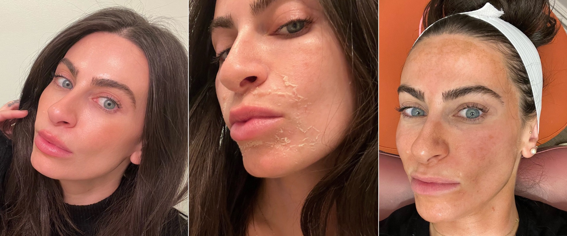 Reviews of Chemical Peels Treatments