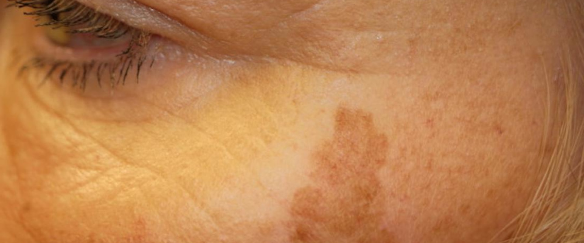 Reduced Appearance of Age Spots and Sun Spots