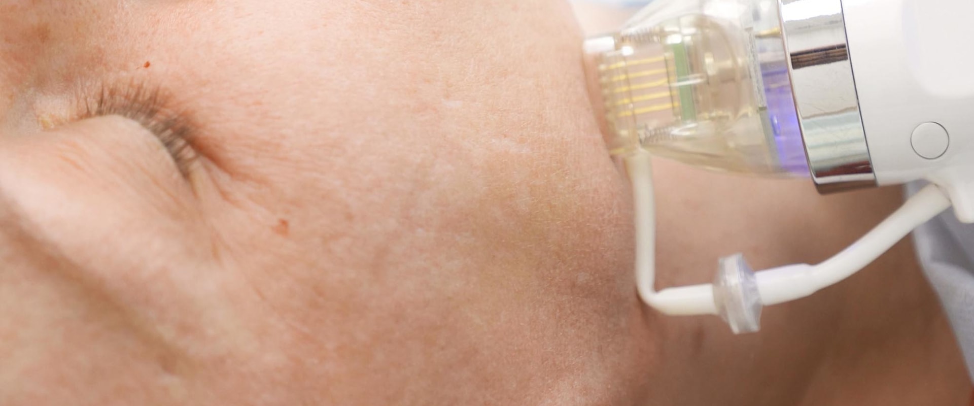 Exploring the Benefits of Radiofrequency Devices