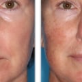 Reviews of Laser Skin Resurfacing Treatments
