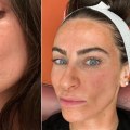 Reviews of Chemical Peels Treatments