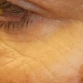 Reduced Appearance of Age Spots and Sun Spots