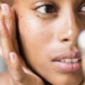 Acne Facial Treatments: A Comprehensive Overview