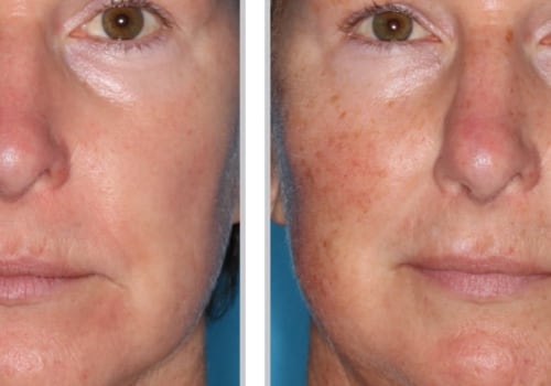 Reviews of Laser Skin Resurfacing Treatments