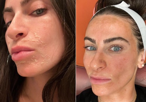 Reviews of Chemical Peels Treatments