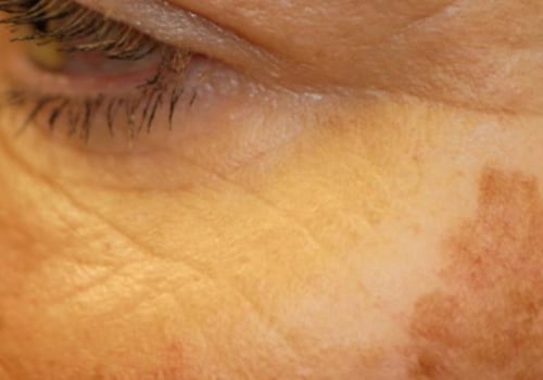 Reduced Appearance of Age Spots and Sun Spots