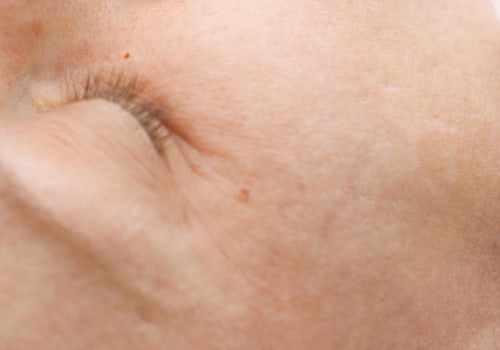 Exploring the Benefits of Radiofrequency Devices